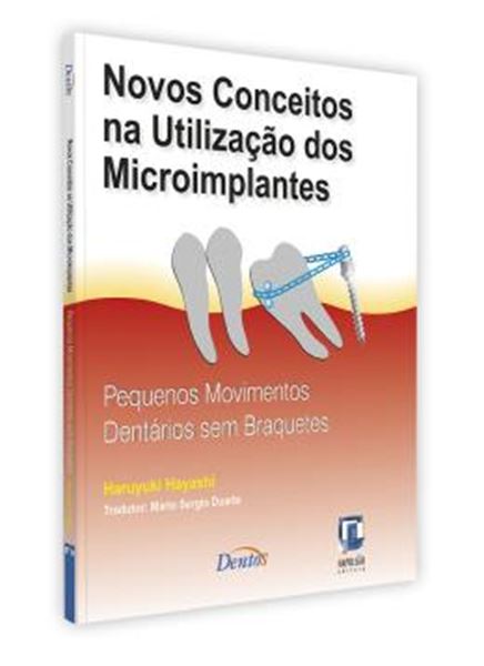 Picture of NOVOS CONCEITOS NA UTILIZACAO DOS MICROIMPLANTES