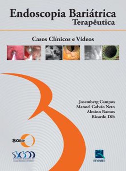 Picture of ENDOSCOPIA BARIATRICA TERAPEUTICA
