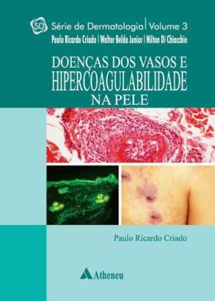 Picture of DOENCAS DOS VASOS E HIPERCOABILIDADE NA PELE - SERIE DERMATOLOGIA - VOL. 3