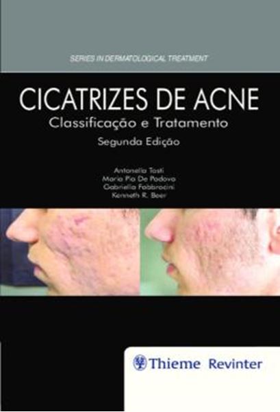 Picture of CICATRIZES DE ACNE - CLASSIFICACAO E TRATAMENTO