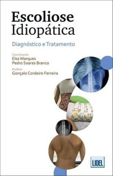 Imagem de ESCOLIOSE IDIOPATICA - DIAGNOSTICO E TRATAMENTO