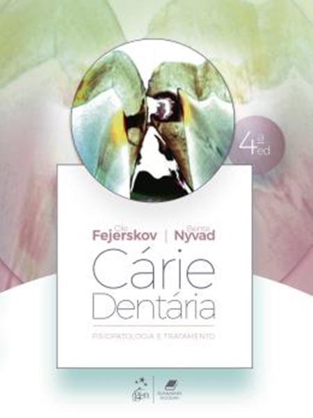 Picture of CARIE DENTARIA: FISIOPATOLOGIA E TRATAMENTO